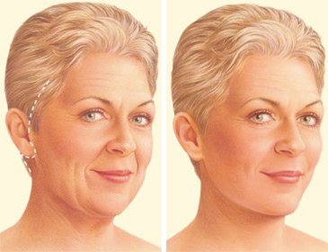 Facelift Surgery Consultation